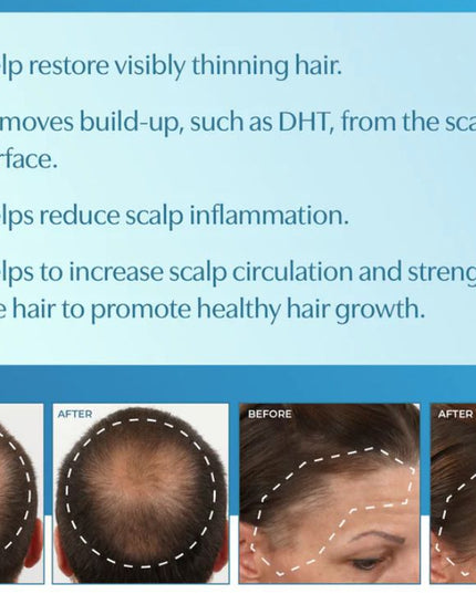 Hair Regrowth Treatment with Minoxidil formulated exclusively for Men is a leave-in, FDA-approved treatment clinically proven to regrow hair and slow down further hair loss.