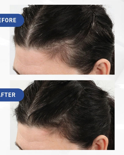 Clinically proven to regrow hair and slow down further hair loss, Hair Regrowth Treatment with Minoxidil is a leave-in, FDA approved treatment available in a targeted, no-mess sprayer application. Reactivate hair follicles to stimulate hair growth and fight hair loss with this clinically proven formula and achieve thicker, fuller looking hair.
