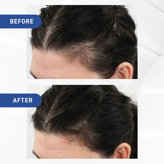 Clinically proven to regrow hair and slow down further hair loss, Hair Regrowth Treatment with Minoxidil formulated exclusively for Women is a leave-in, FDA-approved treatment available in an easy-to-apply foam application. 2 month supply.