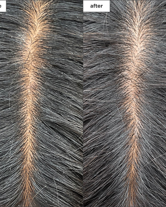 A scalp hydration mask clinically shown to increase scalp hydration by up to 2X.