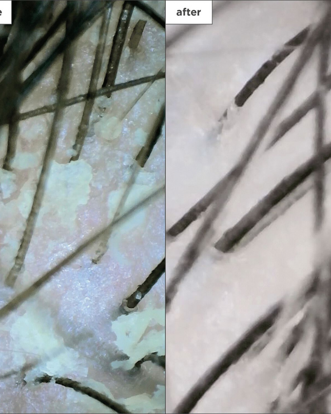 A dandruff relief shampoo that helps eliminate and prevent the recurrence of scalp itching, irritation, redness, and flaking due to dandruff, psoriasis, and seborrheic dermatitis.