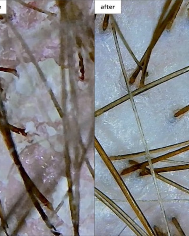 A dandruff relief shampoo that helps eliminate and prevent the recurrence of scalp itching, irritation, redness, and flaking due to dandruff, psoriasis, and seborrheic dermatitis.