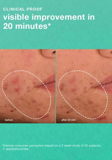 Daily acne-targeting gel.

Acne-targeting daily gel helps prevent breakouts. Lightweight moisturizer with a prebiotic blend hydrates and supports skin’s microbiome, helping aging skin look healthier, now and in the future.