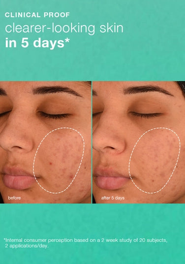 Daily acne-targeting gel.

Acne-targeting daily gel helps prevent breakouts. Lightweight moisturizer with a prebiotic blend hydrates and supports skin’s microbiome, helping aging skin look healthier, now and in the future.