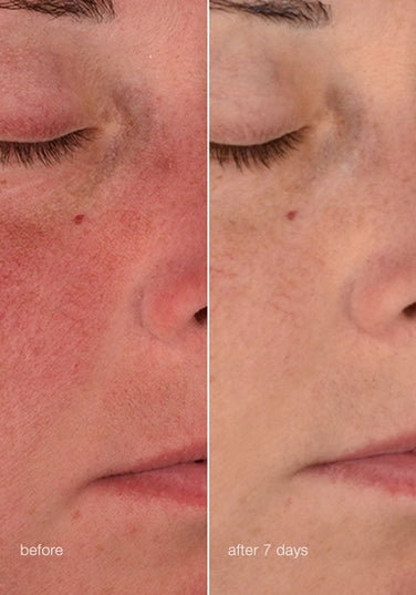 Barrier-repairing moisturizer

Ultra-soothing actives calm on contact – helping to break the pattern of sensitive skin as they immediately comfort and help skin become more resilient over time.