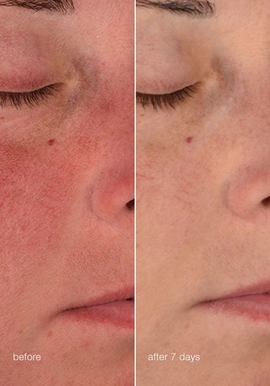 Barrier-repairing moisturizer

Ultra-soothing actives calm on contact – helping to break the pattern of sensitive skin as they immediately comfort and help skin become more resilient over time.