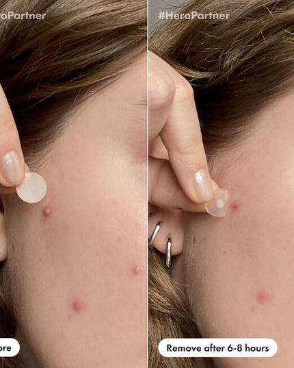 No matter when a pimple strikes, you’ll be prepared with this duo pack. Spot a zit before bed? Hit it with the award-winning Mighty Patch™ Original patch. Woke up with a zit? Use the barely-there Mighty Patch™ Invisible+ patch. Both absorb gunk in 6-8 hours but provide coverage for different times of day. You’ll get 6 of each patch to help you during gunk-mergencies, 24/7.