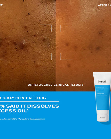 Kit includes travel-size Clarifying Cleanser, Murad's non-stripping, non-drying, foaming gel cleanser that's clinically proven to dissolve excess oil, full-size Rapid Relief Acne Spot Treatment to reduce blemish size and redness in 4 hours, and travel-size Biome-Balancing Clear & Prevent Acne Treatment Serum, an all-over daily treatment serum that clears breakouts and balances the skin’s microbiome to naturally resist future breakouts for clearer, healthier-looking skin