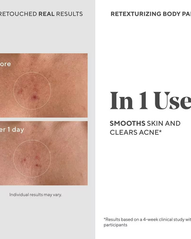 Murad's Retexturizing Body Pads with Salicylic Acid are a super smoothing, acne-fighting body treatment that swiftly wipe out breakouts, KP and ingrown hairs-all while soothing inflamed skin.