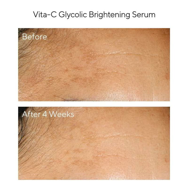 Inspired by Dr. Murad's in-office treatments for hyperpigmentation, this regimen helps reduce the look of dark spots and uneven tone, while sunscreen helps defend against environmental aggressors.