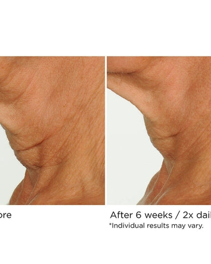 You can simultaneously treat crepiness, laxity, and texture issues on the delicate skin of the neck and décolleté in as little as 4 weeks—with no irritation. NassifMD’s powerful proprietary Upfinity Peptide Complex™ was made specifically to stimulate fast results in the tricky area below the chin.