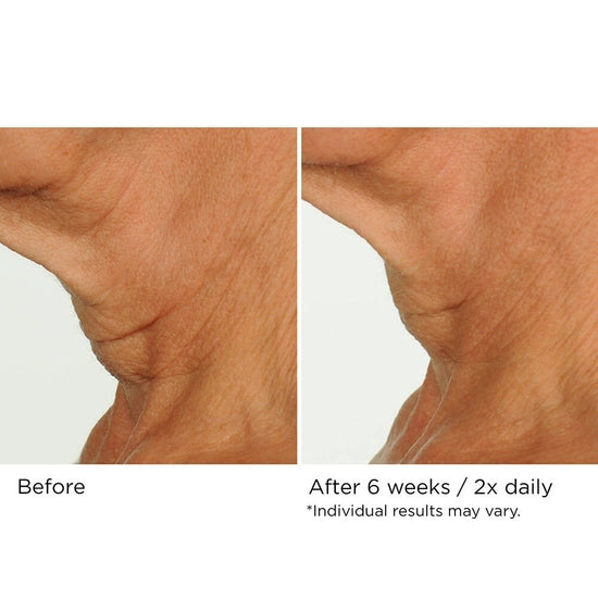 You can simultaneously treat crepiness, laxity, and texture issues on the delicate skin of the neck and décolleté in as little as 4 weeks—with no irritation. NassifMD’s powerful proprietary Upfinity Peptide Complex™ was made specifically to stimulate fast results in the tricky area below the chin.
