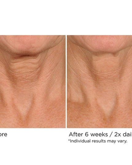 You can simultaneously treat crepiness, laxity, and texture issues on the delicate skin of the neck and décolleté in as little as 4 weeks—with no irritation. NassifMD’s powerful proprietary Upfinity Peptide Complex™ was made specifically to stimulate fast results in the tricky area below the chin.