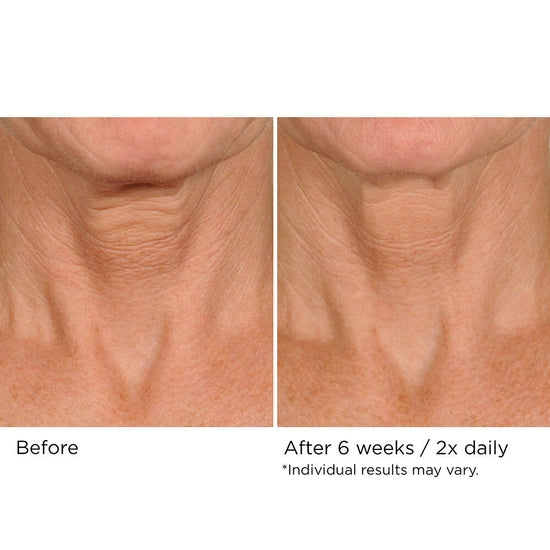 You can simultaneously treat crepiness, laxity, and texture issues on the delicate skin of the neck and décolleté in as little as 4 weeks—with no irritation. NassifMD’s powerful proprietary Upfinity Peptide Complex™ was made specifically to stimulate fast results in the tricky area below the chin.