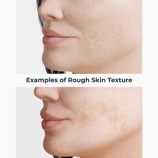 Improve chronic rough skin texture with just a few swipes! These skin retexturizing treatment pads have a proprietary synergistic blend of, Niacinamide, Hyaluronic Acid, Retinol and Mandelic Acid. The slower but deeper absorption rate of mandelic acid helps supercharge all ingredient benefits, resulting in smoother, brighter, more even looking skin. Skip the lasers at the medical spa and give these a try, you’ll see progressive improvement over just 4 weeks!