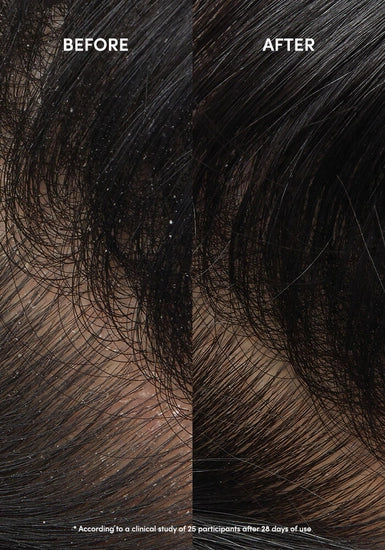 This gentle shampoo with salicylic acid helps reduce flaking, itching, and irritation associated with dandruff while leaving hair feeling clean and soft.