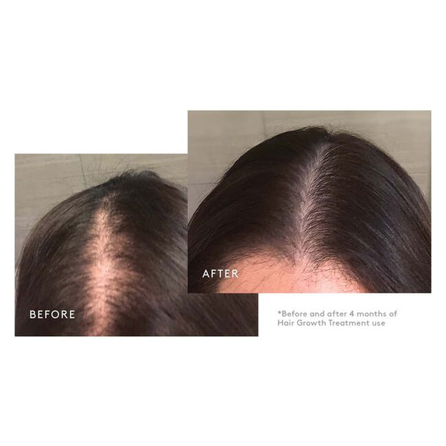 A Minoxidil-based regimen that nourishes the scalp and reactivates hair follicles to stimulate growth. The three-step system includes the Shampoo for Thinning Hair, Conditioner for Thinning Hair and Minoxidil 5% Foam. This regimen is ideal for moderate to severe hair loss due to: hereditary factors, hormonal fluctuations, nutritional deficiencies, and/or stress. Safe for chemically treated or colored hair.