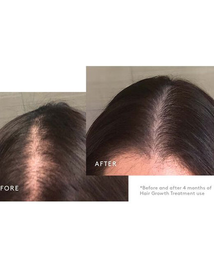 A Minoxidil-based regimen that nourishes the scalp and reactivates hair follicles to stimulate growth. The three-step system includes the Shampoo for Thinning Hair, Conditioner for Thinning Hair and Minoxidil 5% Foam. This regimen is ideal for moderate to severe hair loss due to: hereditary factors, hormonal fluctuations, nutritional deficiencies, and/or stress. Safe for chemically treated or colored hair.