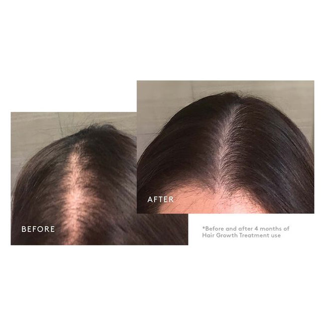A Minoxidil-based regimen that nourishes the scalp and reactivates hair follicles to stimulate growth. The three-step system includes the Shampoo for Thinning Hair, Conditioner for Thinning Hair and Minoxidil 5% Foam. This regimen is ideal for moderate to severe hair loss due to: hereditary factors, hormonal fluctuations, nutritional deficiencies, and/or stress. Safe for chemically treated or colored hair.